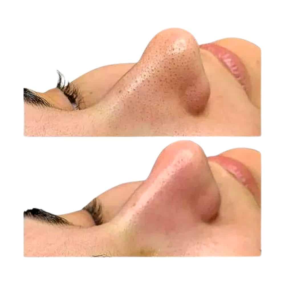 resultados de herramientas para el acne